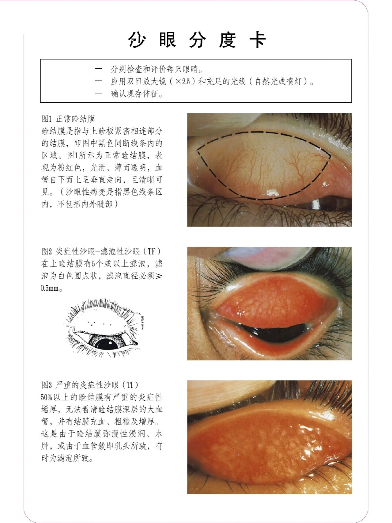 沙眼衣原体症状图片