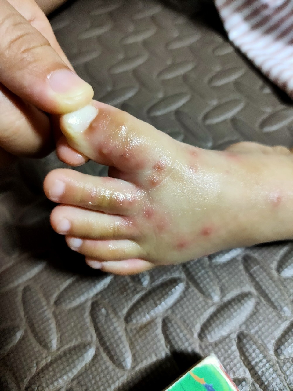 宝宝被蚂蚁咬了 去生态园玩被蚂蚁群咬了怎么办?