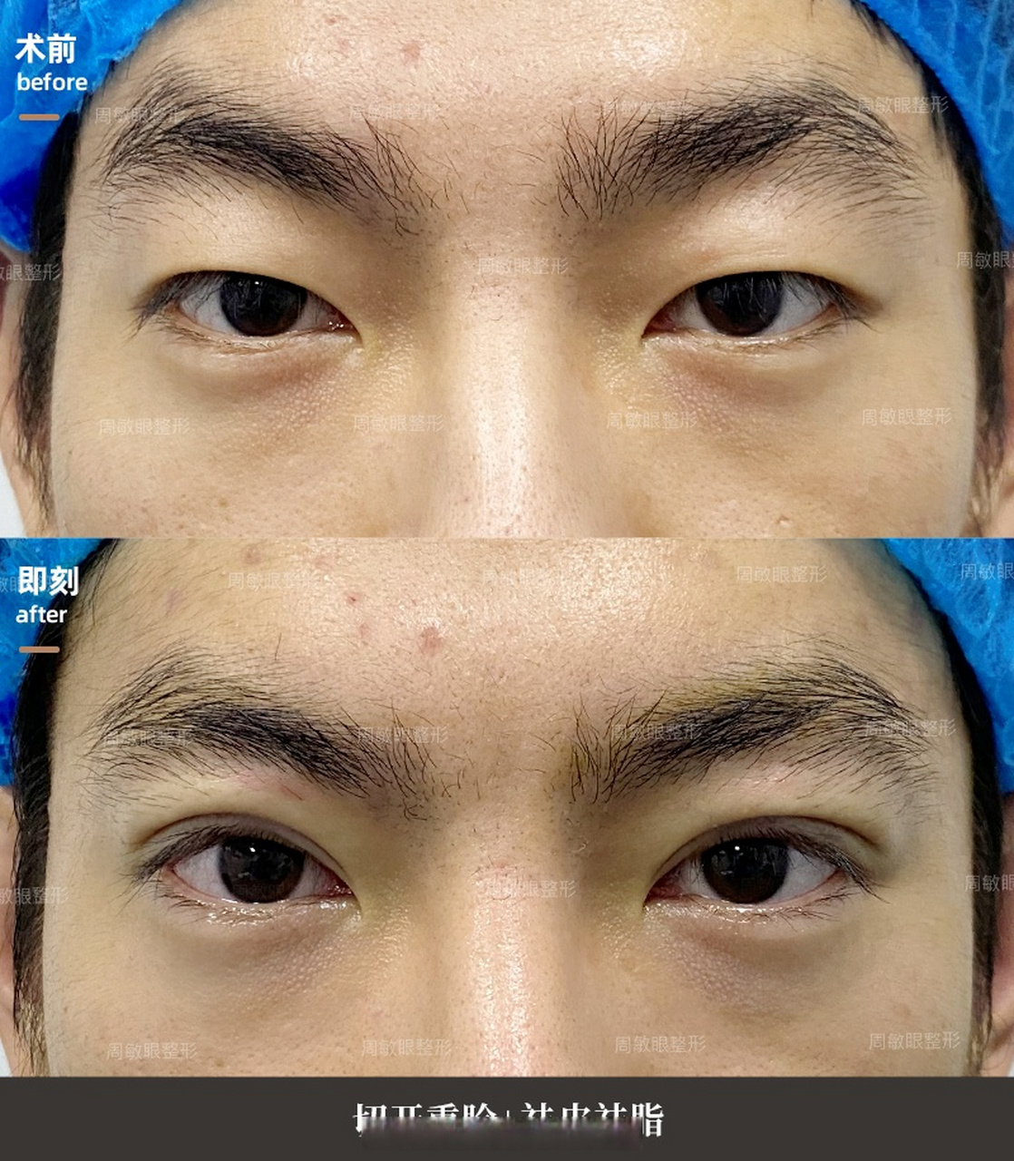 【男士双眼皮案例】 男生双眼皮一定要窄和自然,女生平时会上妆及有