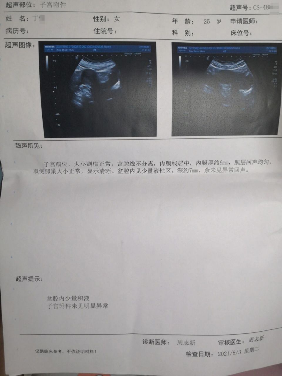 左侧卵巢囊肿一星期没有了,真是万幸.