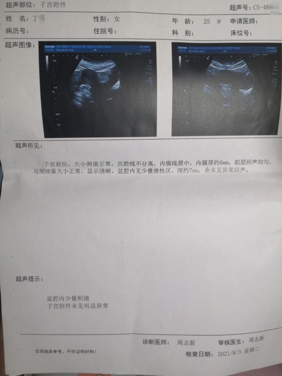 左侧卵巢囊肿一星期没有了,真是万幸