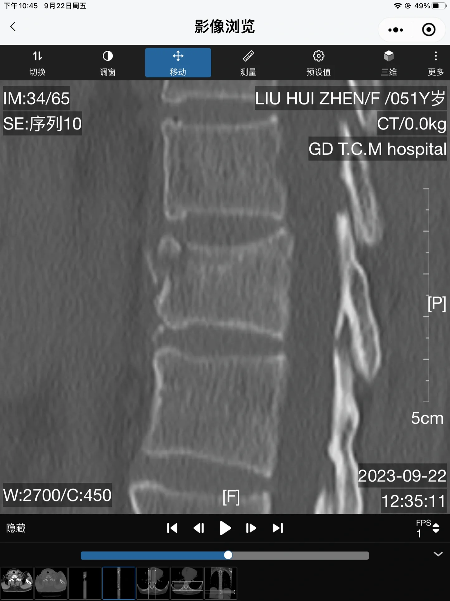 t11脊椎压缩骨折