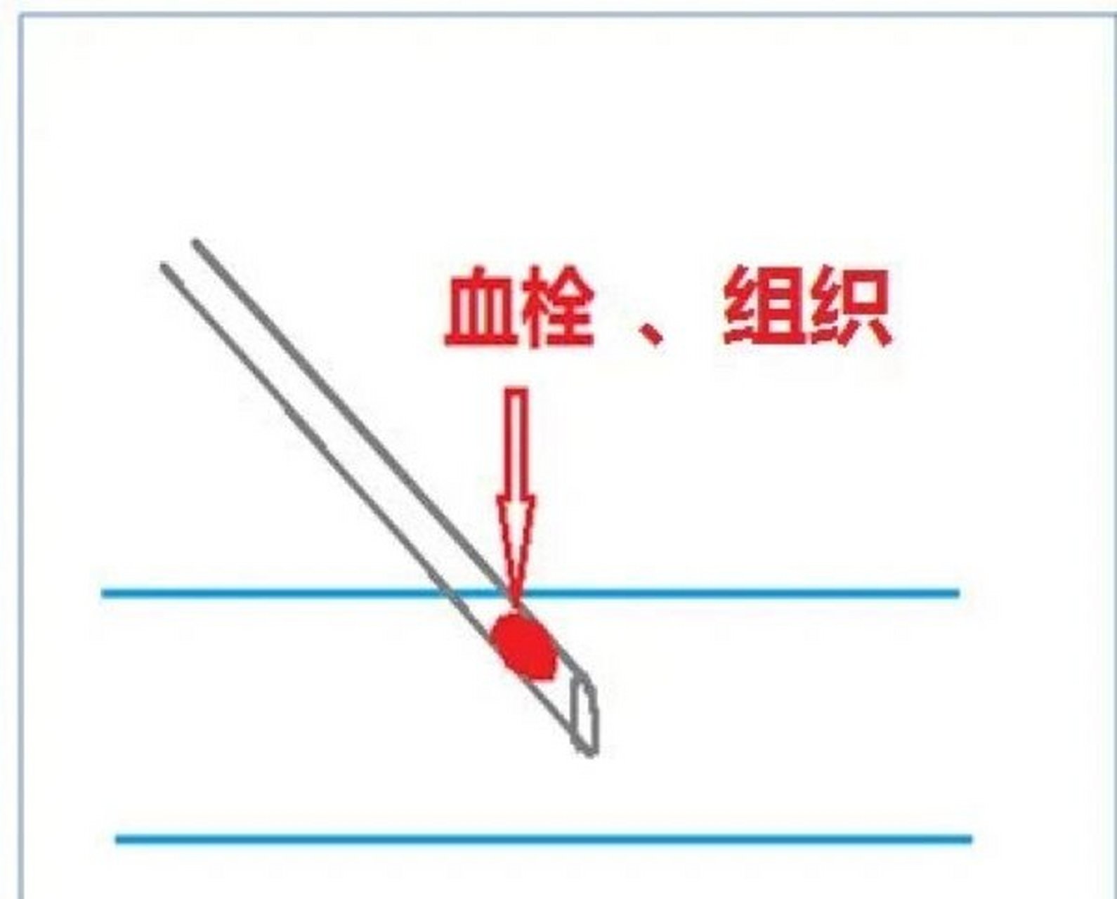 针头斜面向上的图片图片