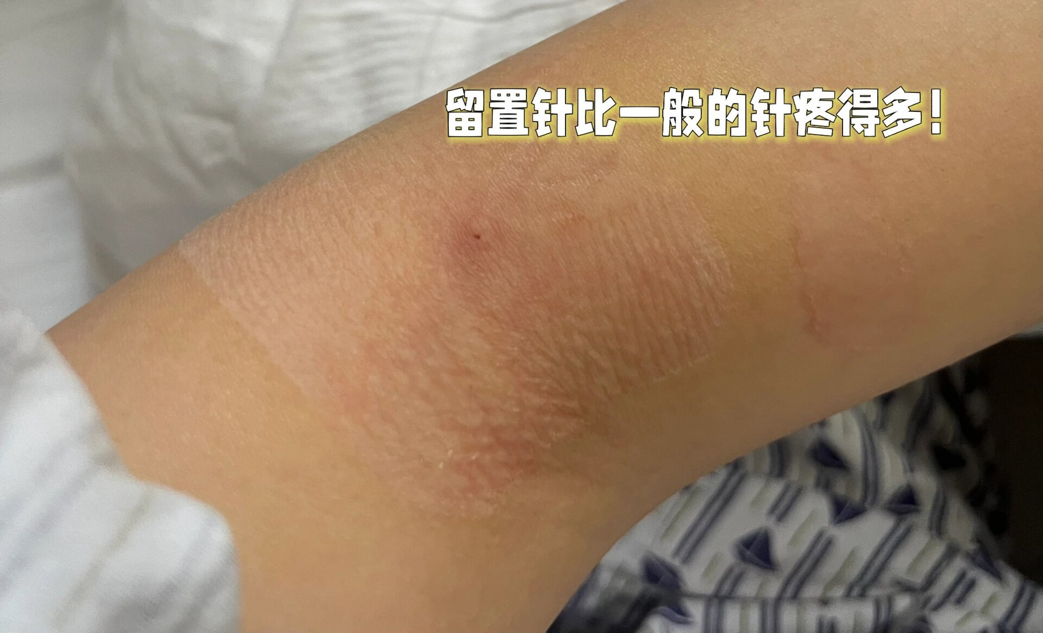 心脏射频消融术(术中)经验分享(上) ⚡️正式手术前:早上11:00