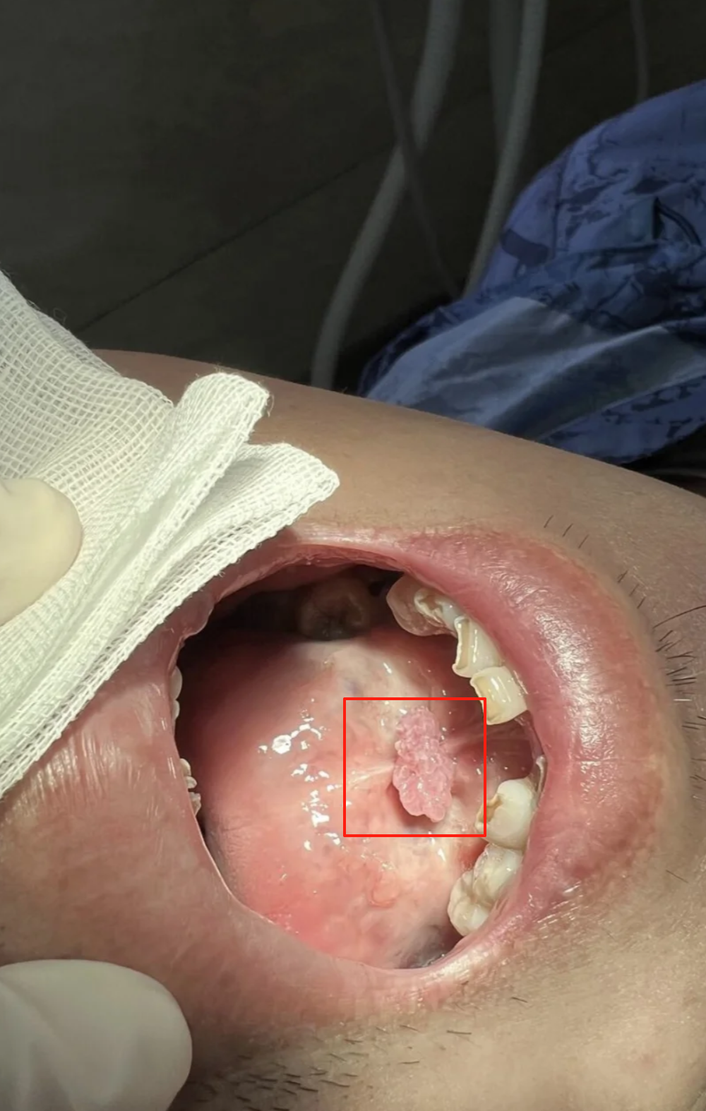 这两种病毒主要会引起尖锐湿疣,常见症状包括皮肤长疣体,瘙痒,触碰时