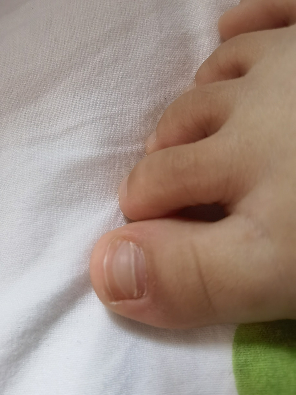 宝宝脚趾甲有横线是怎么回事 今天帮宝宝剪指甲,发现脚趾甲上不知道
