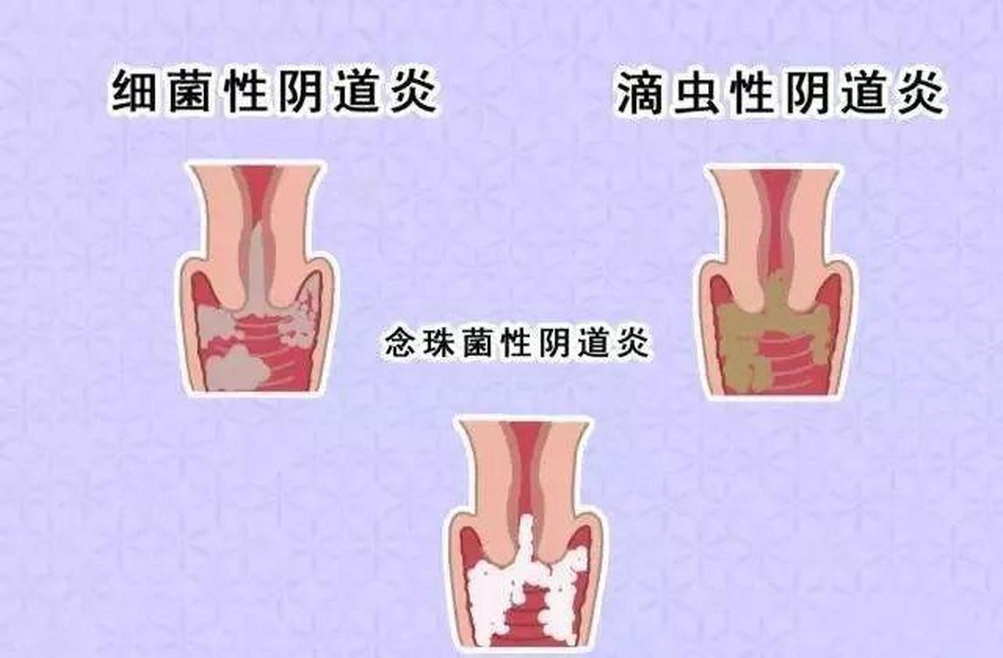 2,內褲黃綠色結痂分泌物的原因 02內褲上出現黃綠色結痂分泌物,在