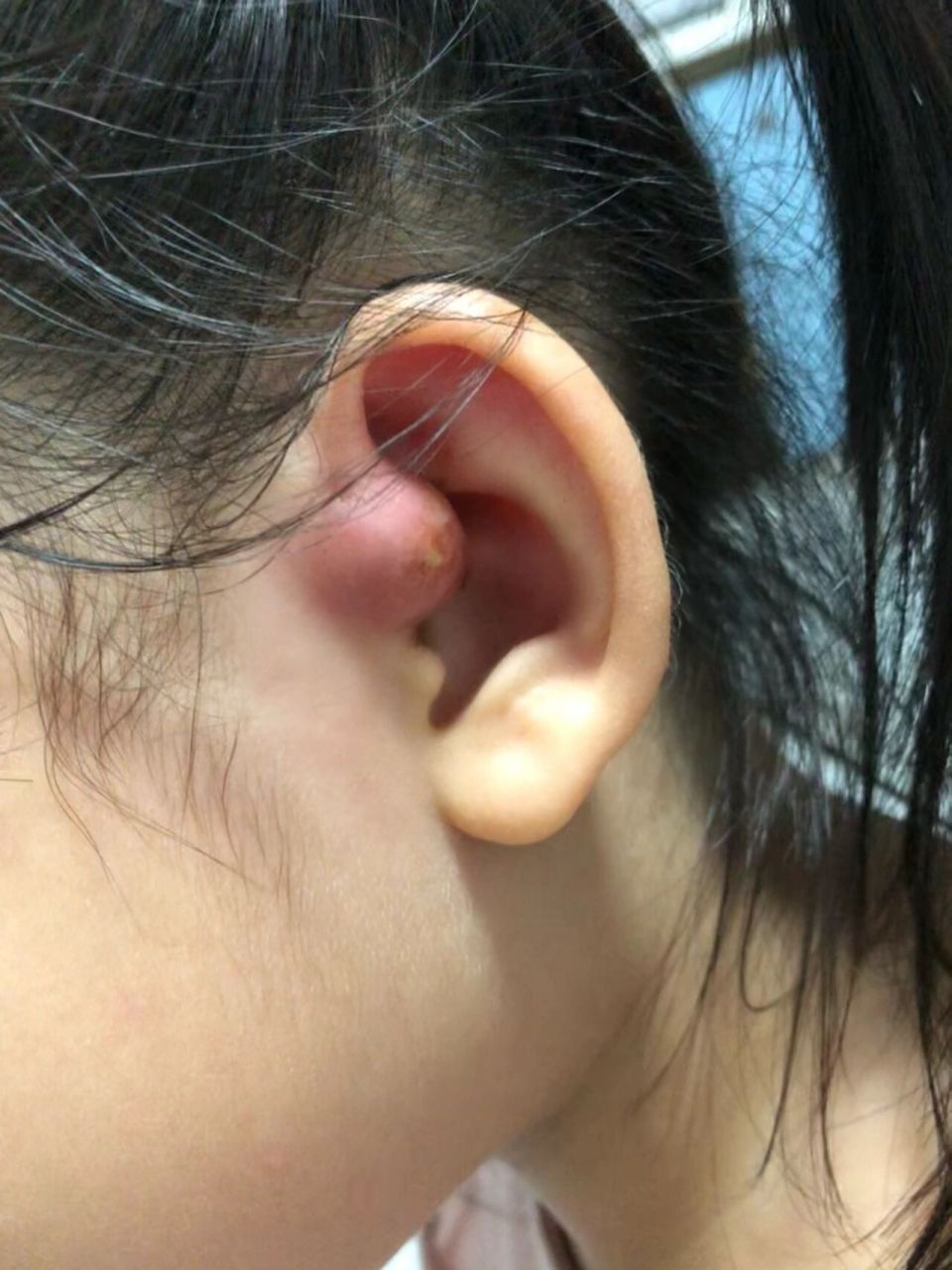 耳前瘘管手术 记录挣扎了4年的耳前瘘管 今年4月份