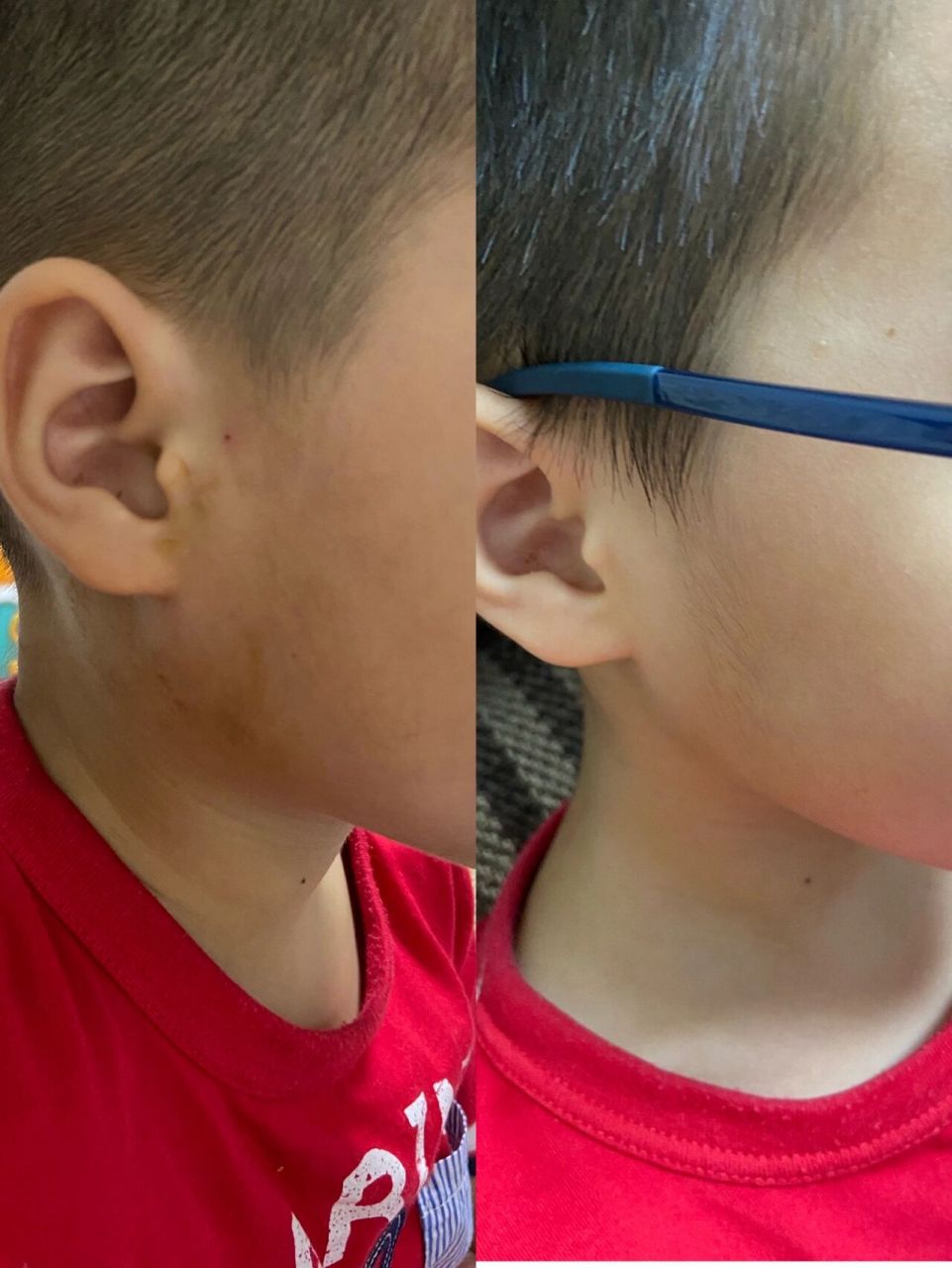 宝宝的腮腺炎经历 今年5月13日,宝宝突然说左边耳朵下面有点疼,量了下