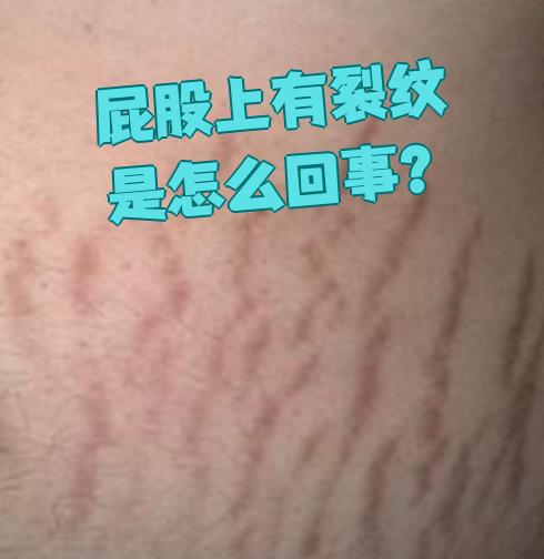 屁股上出现裂纹可能是肥胖纹,也可能是肛门部位的湿疹或肛裂