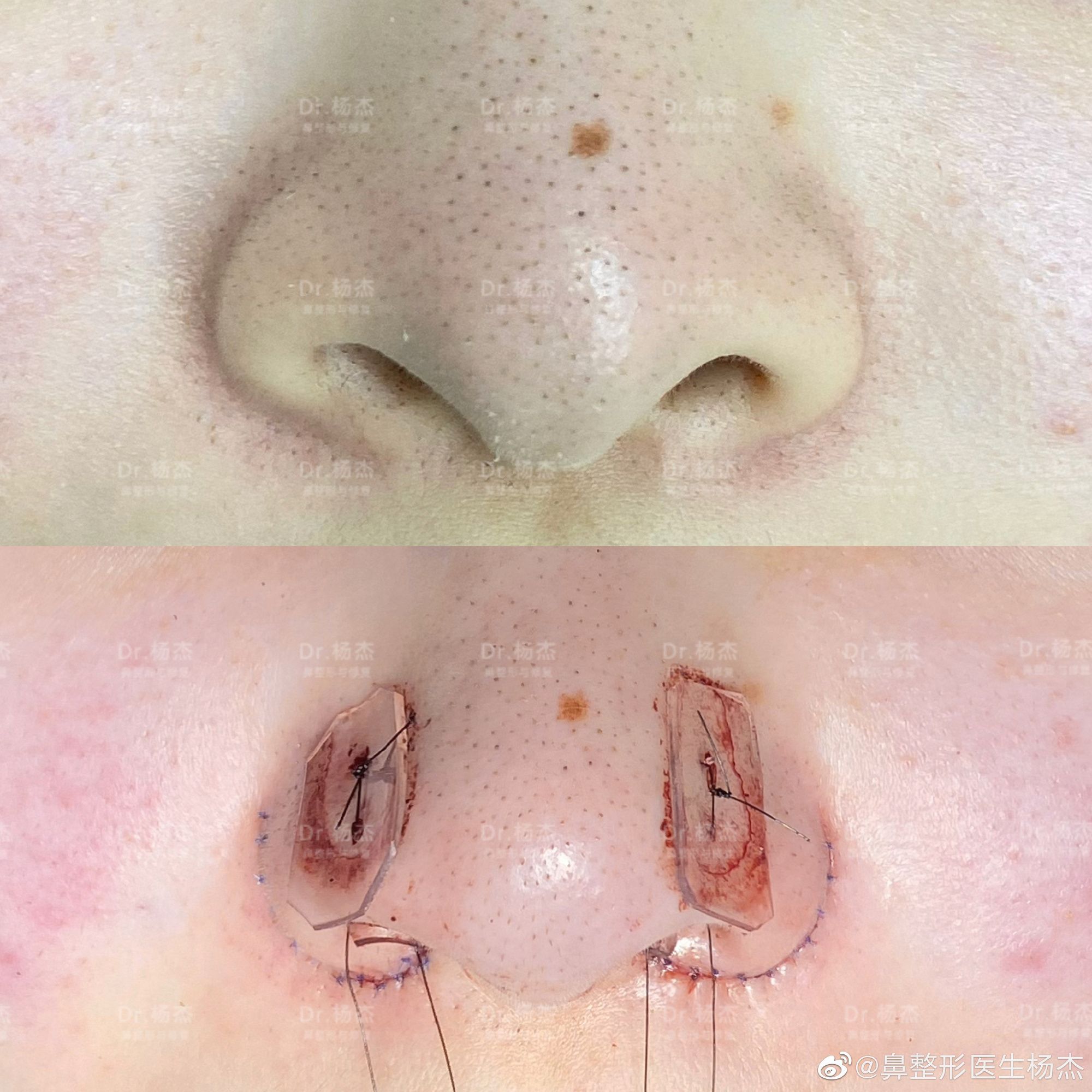 内外联合鼻翼缩小鼻翼组织修复鼻翼缘退缩鼻槛上提