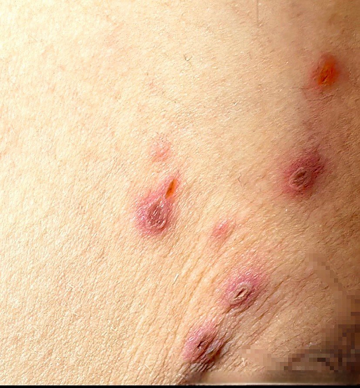 医生你好,在腹股沟的位置起了几个这样的疹子,快一周了吧,最开始是有