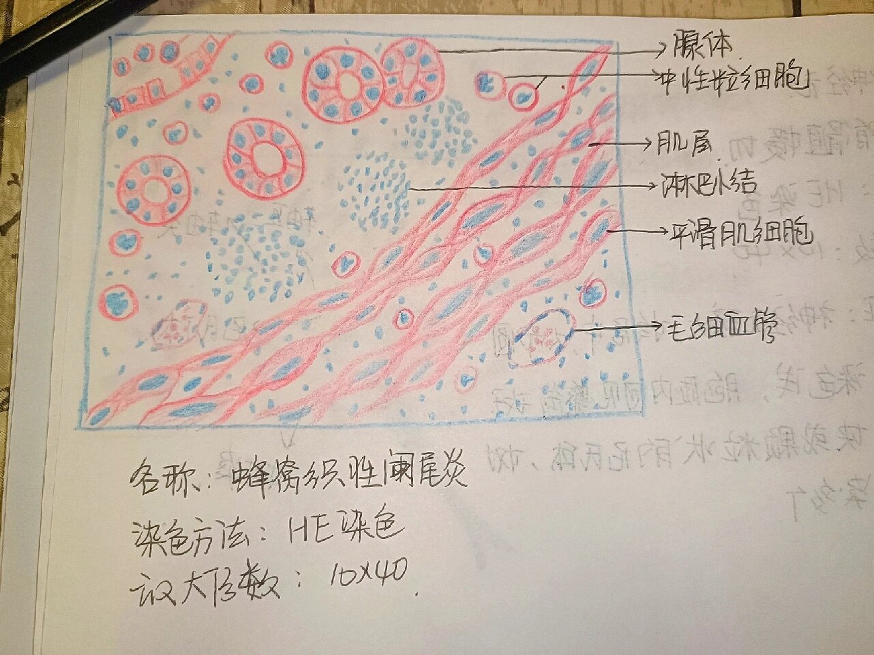 阑尾炎红蓝铅笔图图片