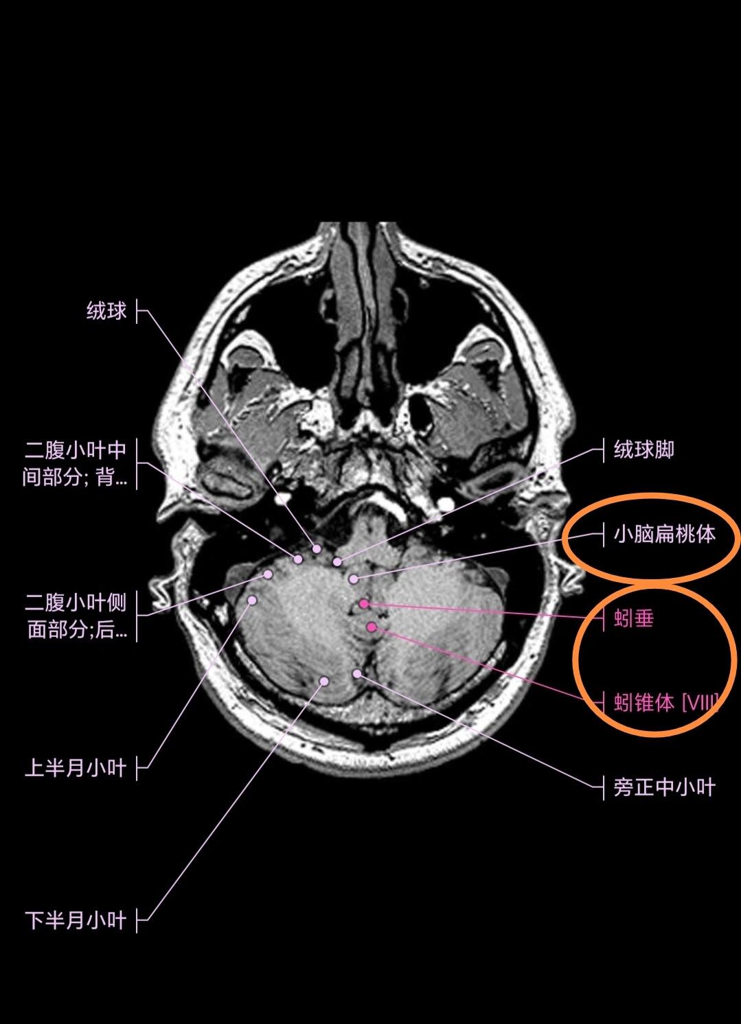 小脑蚓部正常影像解剖图片