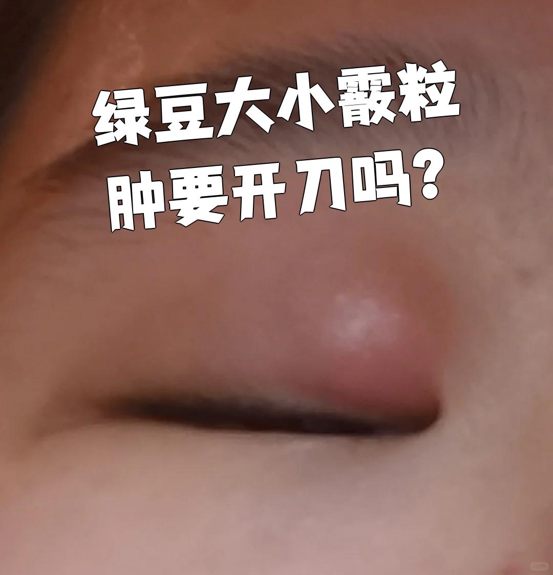 绿豆大小霰粒肿要开刀吗?