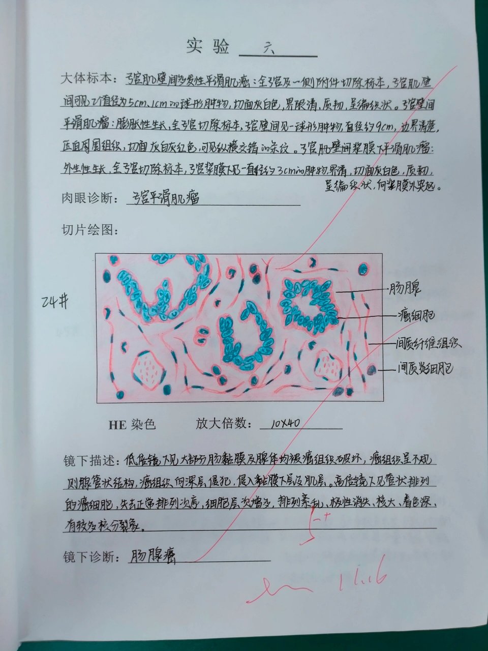 肠腺癌 红蓝铅笔图片