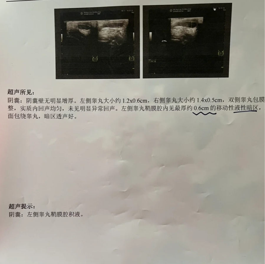 睾丸有下坠感还疼,可能是这些原因: