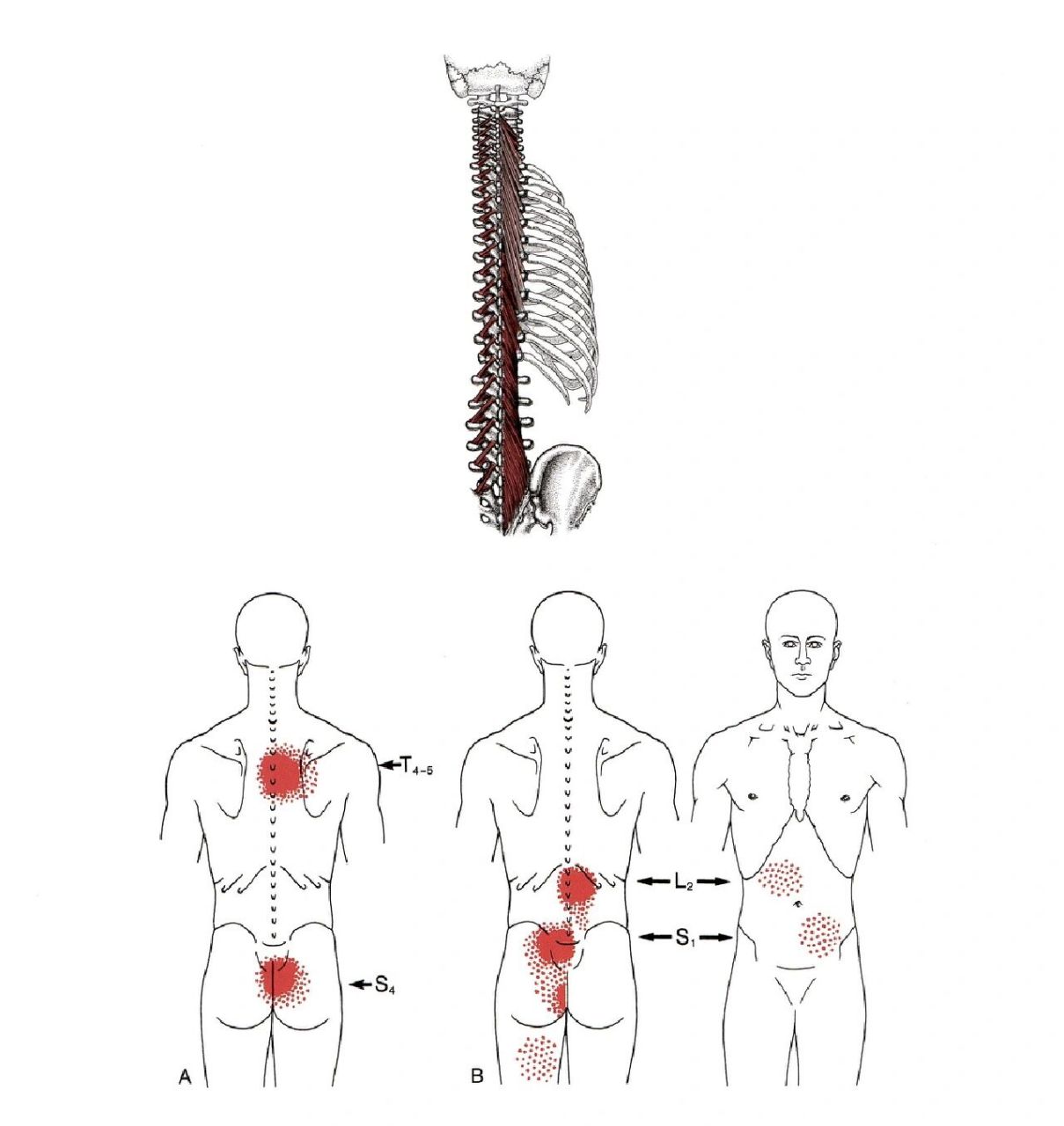 肌筋膜疼痛及功能障碍(竖脊肌和横突棘肌)  胸腰椎旁肌的触发点是后背
