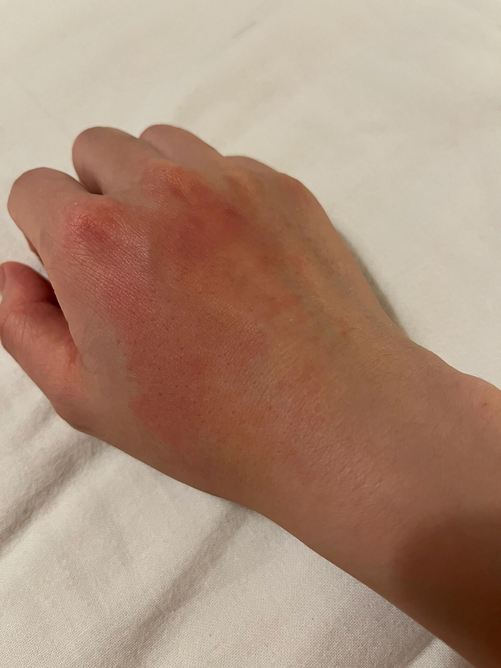 求解大神 莫名其妙手背红肿痛
