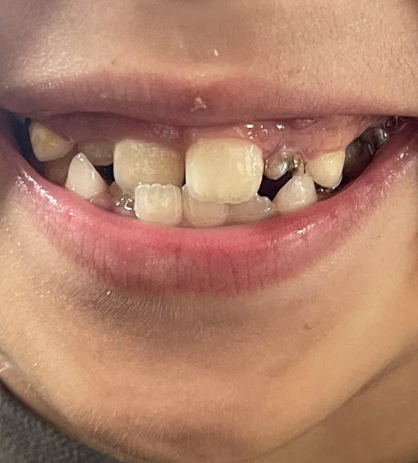 这个年龄段牙齿还在生长,矫正效果比较好