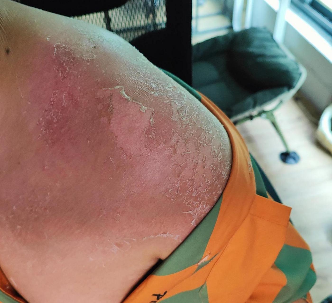 自从上周末在海边放飞自我并严重晒伤后,目前已进入脱皮阶段