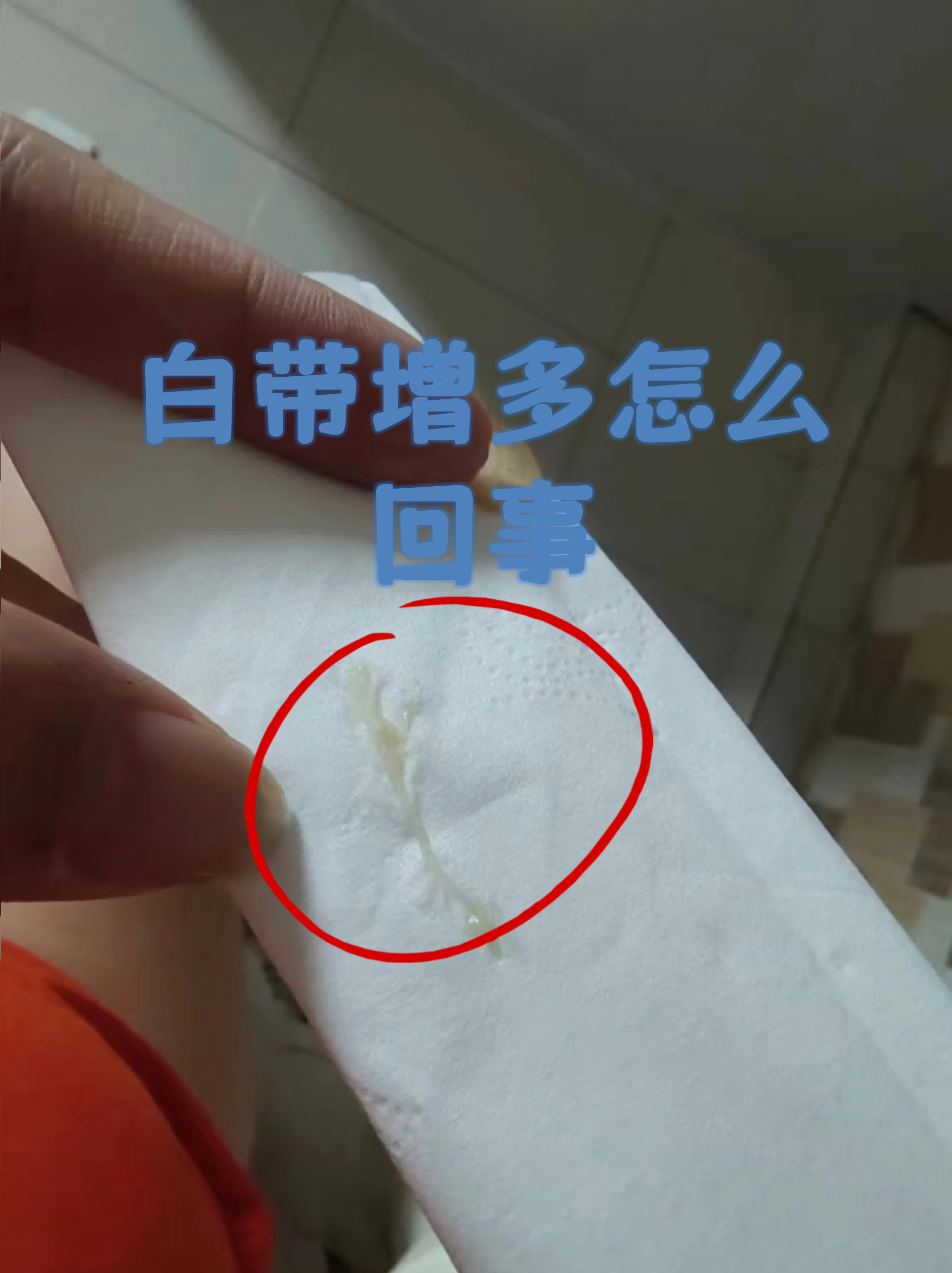 正常白带呈透明或乳白色,无臭味,若出现颜色,质地或气味改变,需警惕