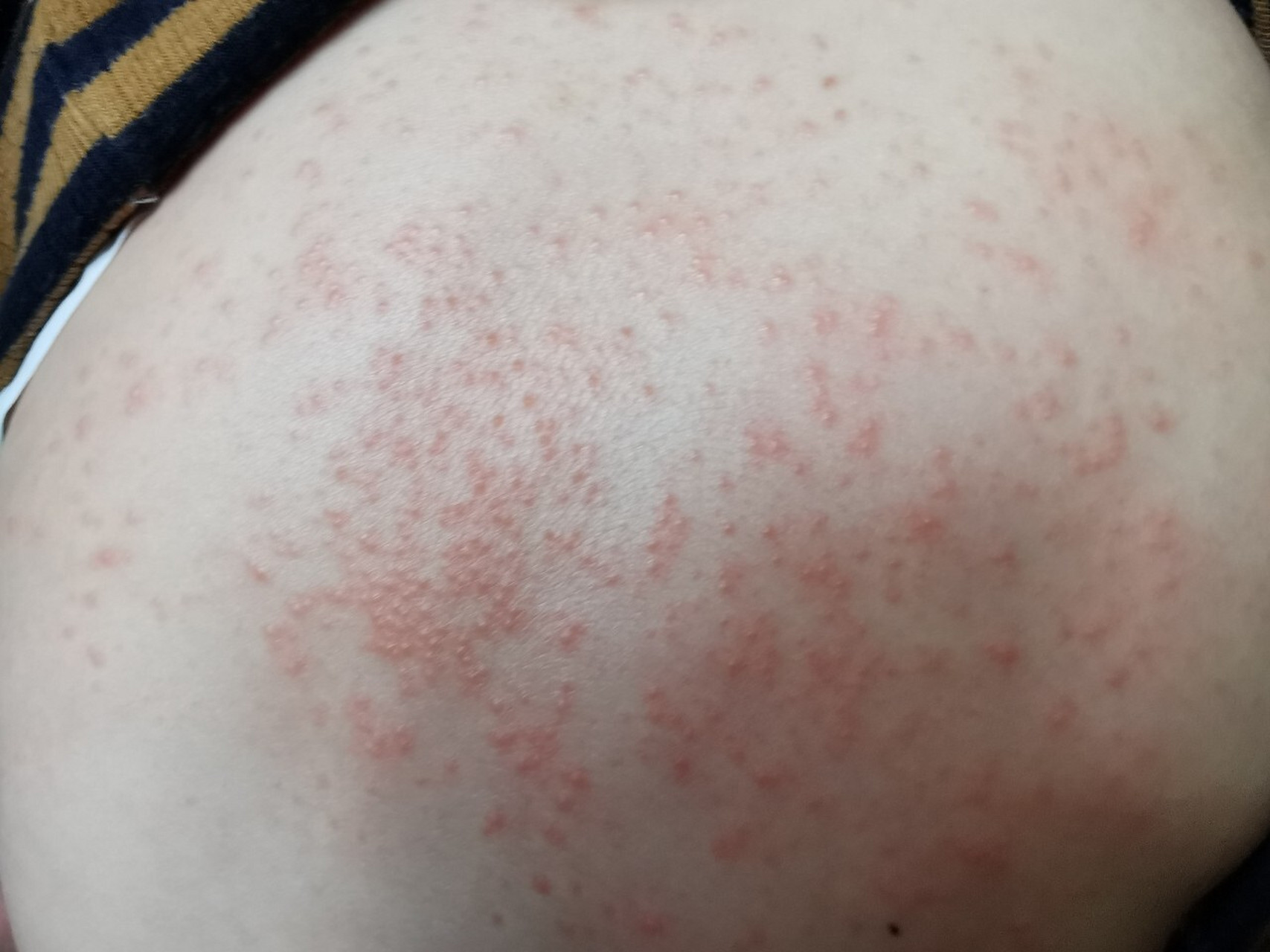 求助,宝宝背部红疹 宝宝背上起来红疹好多,擦了药不起作用,有谁知道这