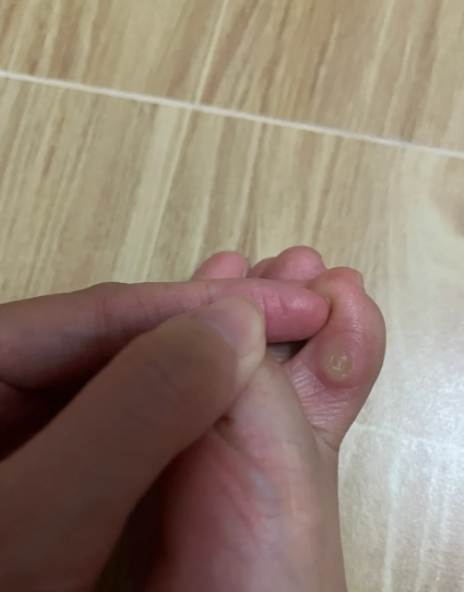 鸡眼一般长在什么部位?