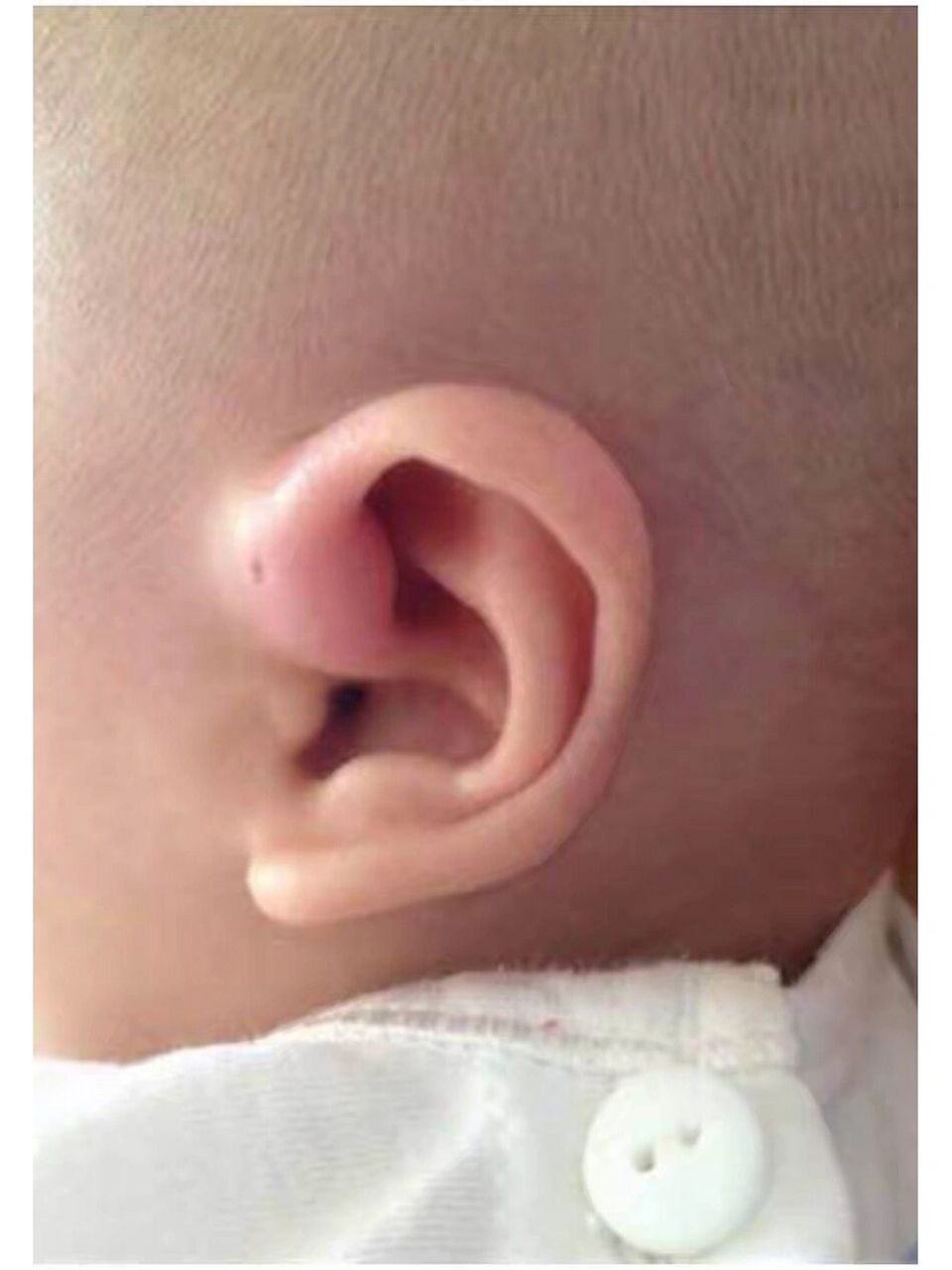 宝宝耳朵上面的小孔叫仓眼先天性耳前瘘管 有的人耳朵上面有一个