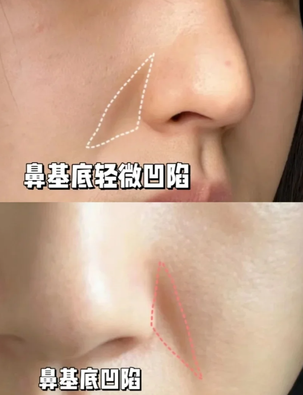 填充鼻基底7年,研究出来的不移位打法,码住!