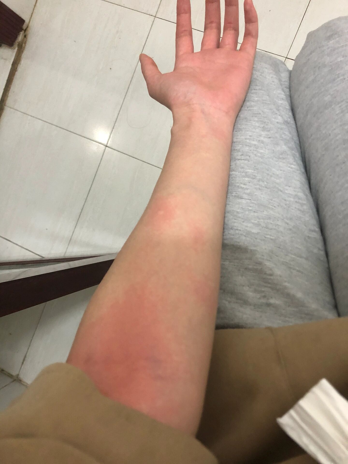 吃小龙虾过敏了 谁懂啊,之前吃的少没有过敏过,结果,今天一次性吃太多