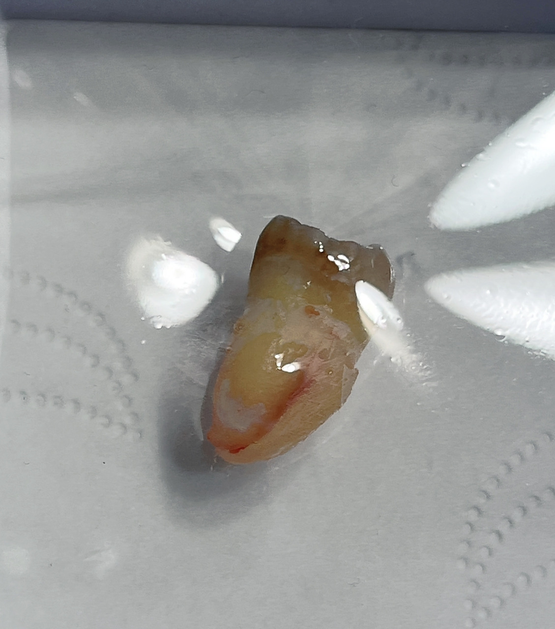 拔智齿做根管治疗 一个月前感觉到有个小洞,当是有点事忙就想晚点去