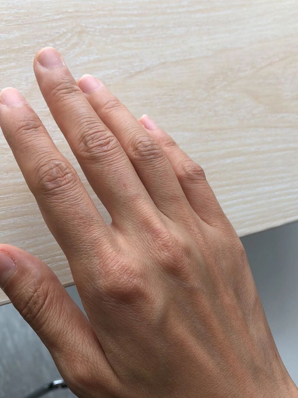 尺神经卡压 从一开始手指无力无法伸直,现在第44天,麻感下降,手可以