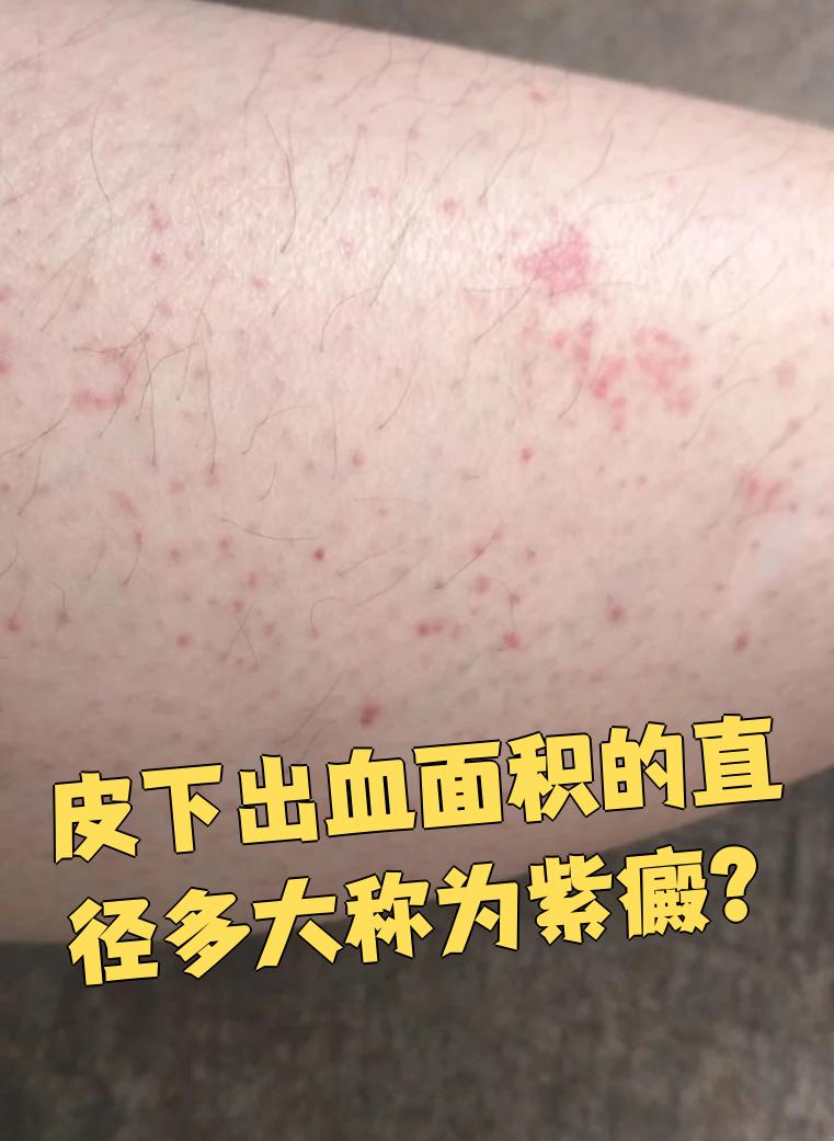 皮下出血面积的直径在1
