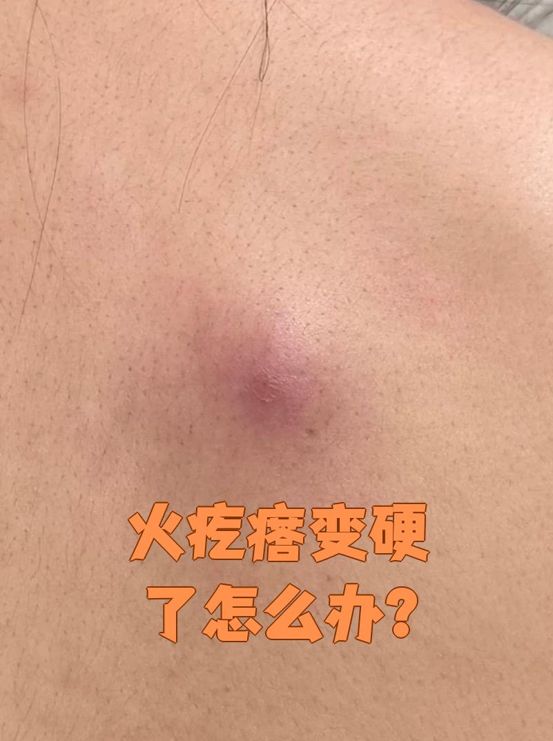 变硬是正常的发展过程,这时候需要及时处理