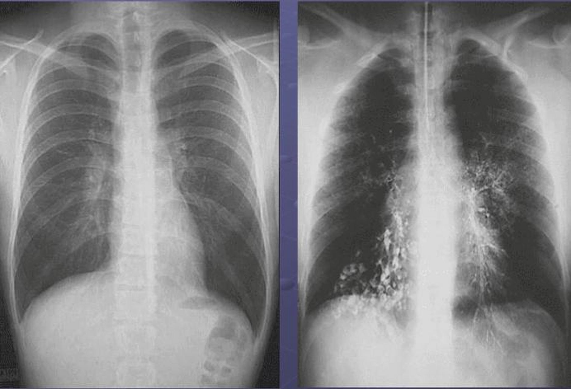 支气管扩张症具有复发率高,病程长,肺功能进行性下降等特点,严重