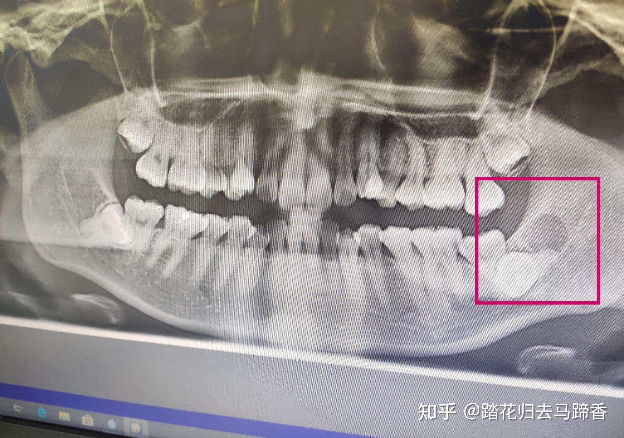 上下颌骨ct平扫解剖图片