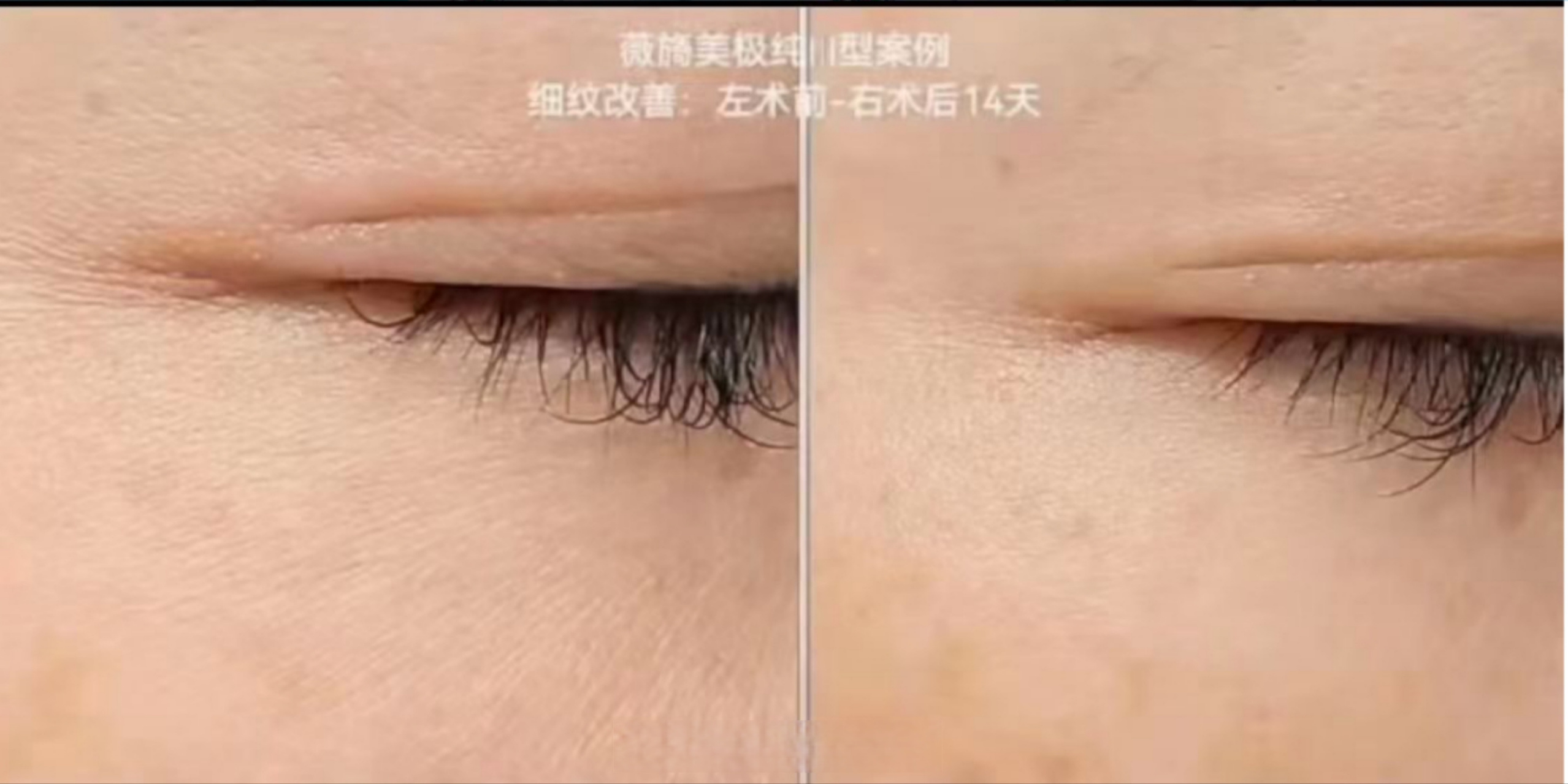 #薇旖美# #眼周抗衰# #干纹细纹#  今天分享两个用薇旖美三型胶原蛋白