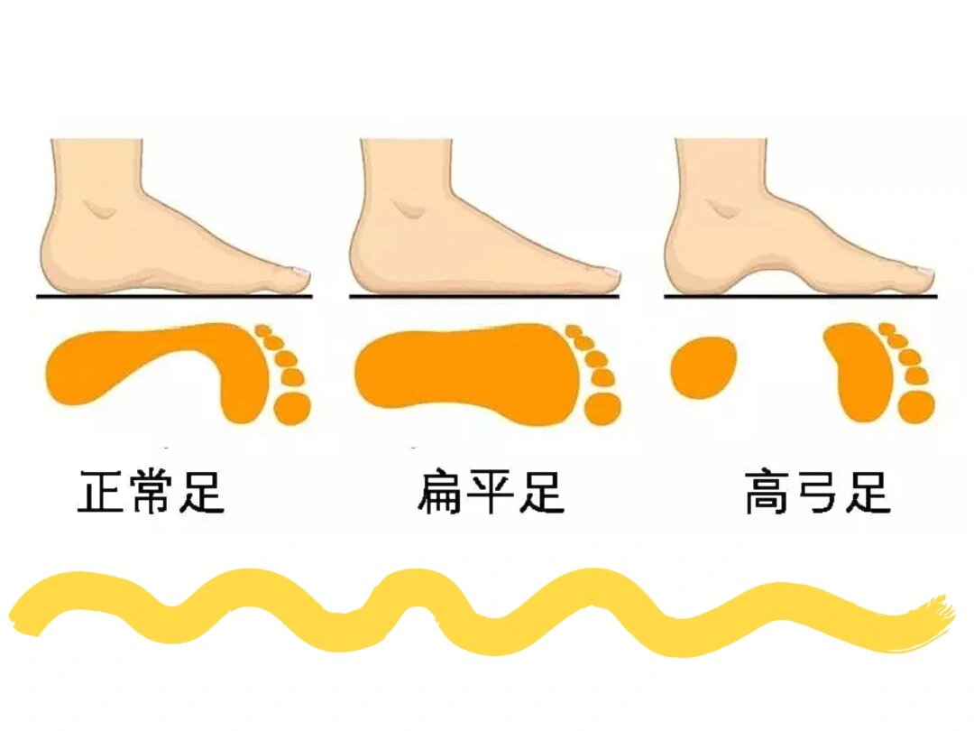 小孩扁平足图片 判断图片