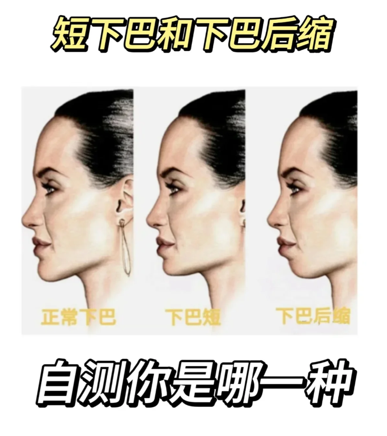 短下巴 如果你的下巴比较短,但是整体的五官比例是好看的,那就不需要