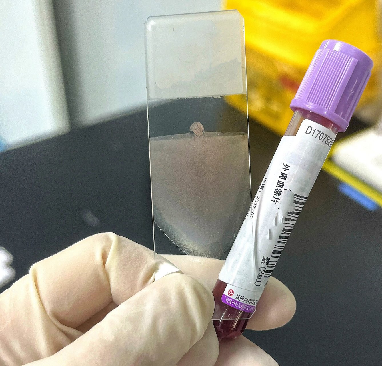 得这张血涂片可以打多少分 哈哈 一气呵成 每次推血涂片讲究的是手感