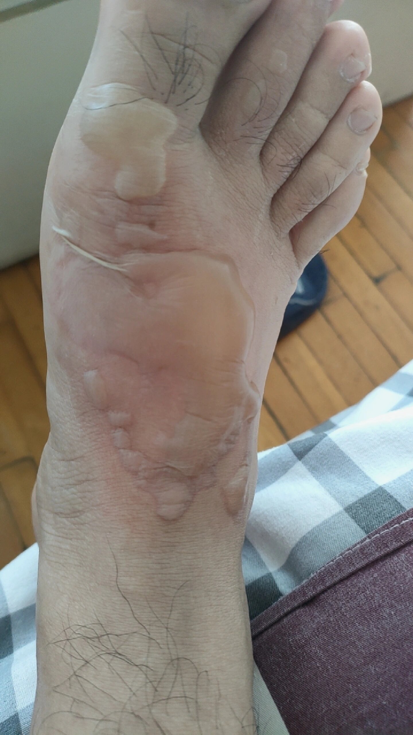 开水烫伤记录痊愈过程 11月8号早晨脚有点肿胀,大泡小泡全起来了,下床