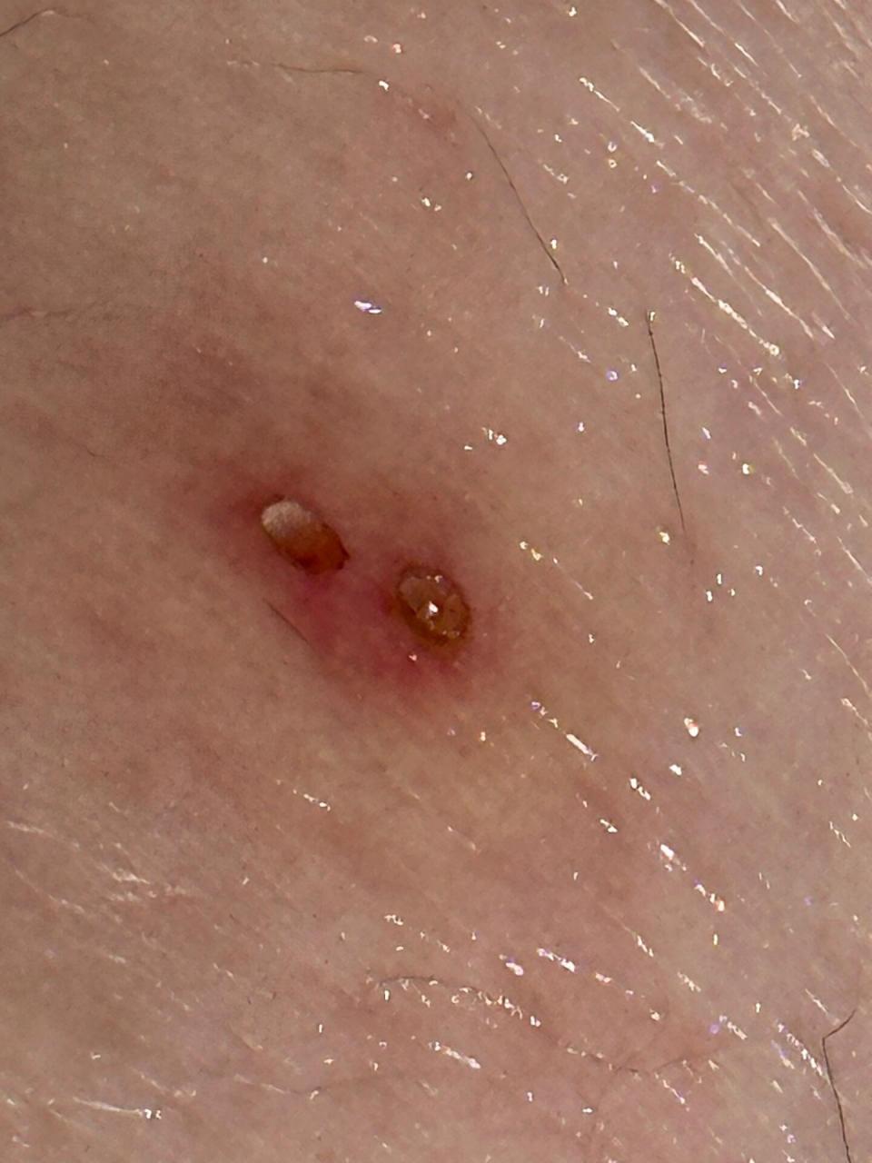 在key west疑似被红火蚁咬出两个洞 迈阿密开去key