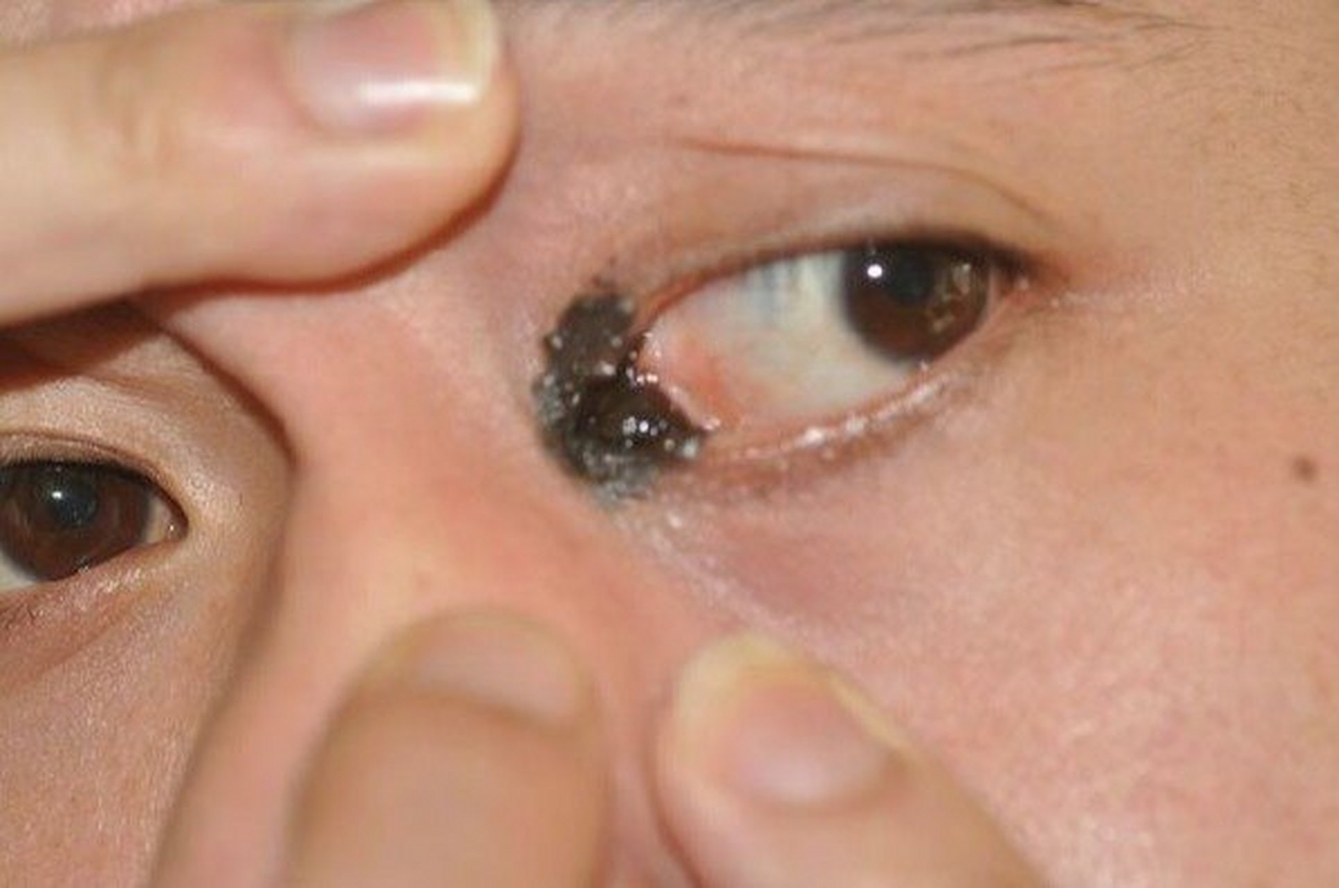 根据大小,一般直径小于患者手掌的成为先天性小痣, 大于手掌的称为