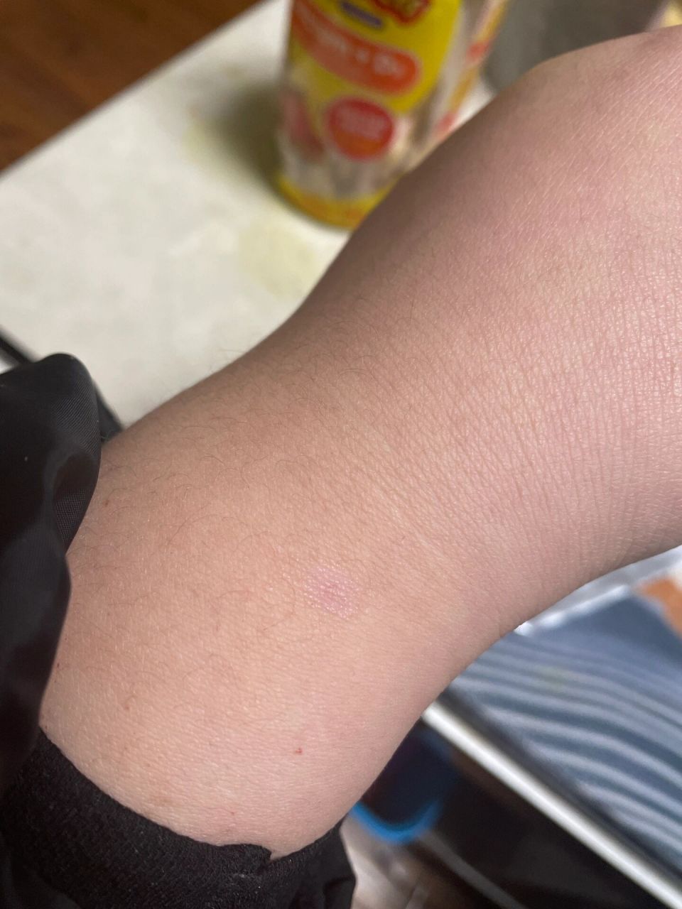 人感染猫癣,特效药 无意之中擦了这个药,3天结痂淡化.