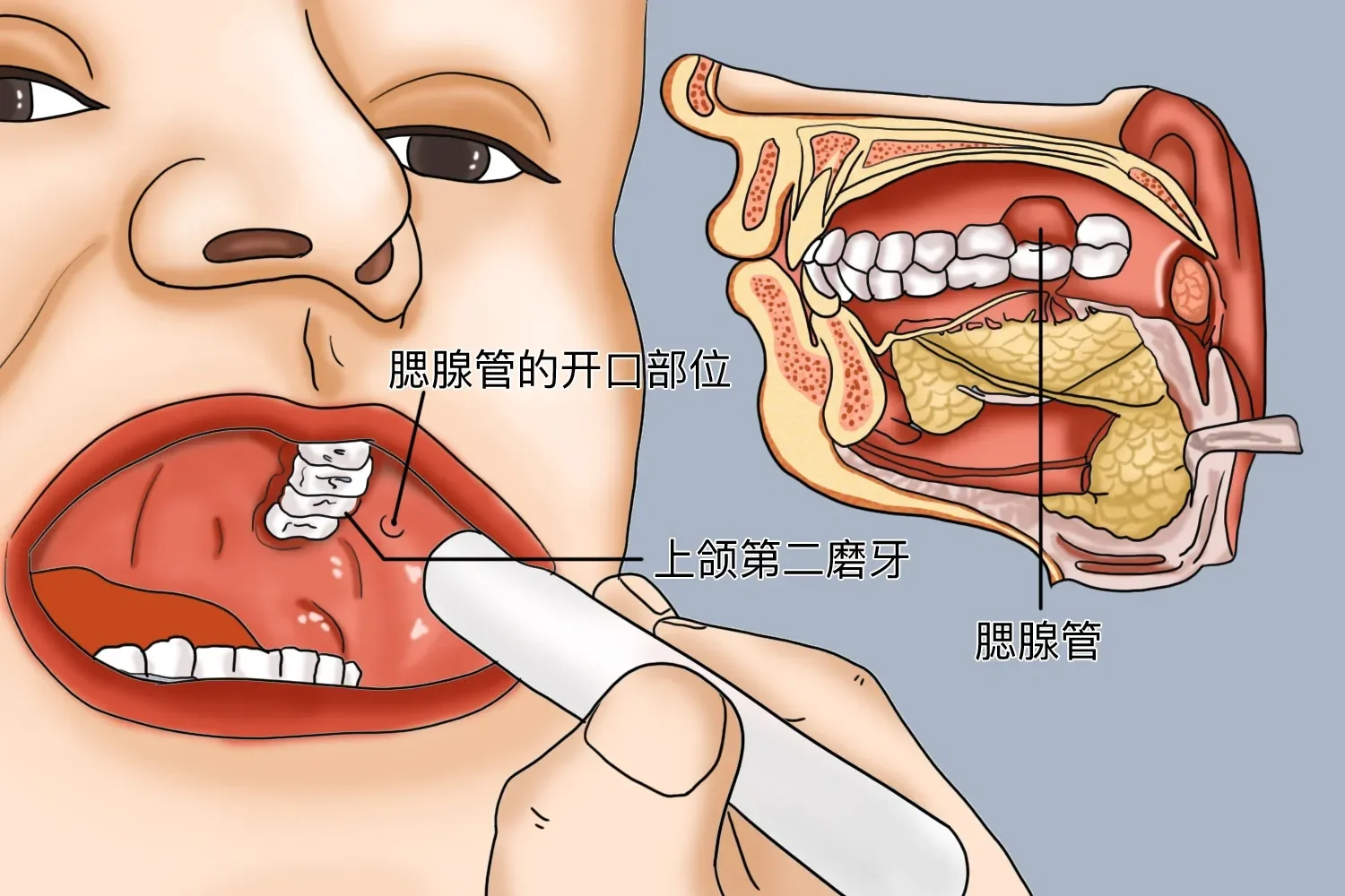 腮腺管发炎图片