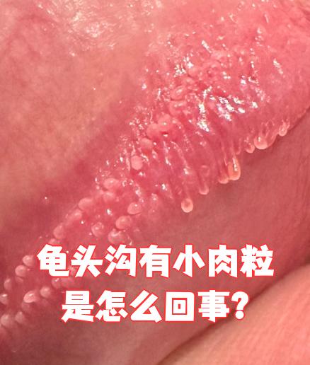 龟头沟出现小肉粒最常见的原因是冠状沟珍珠疹或尖锐湿疣