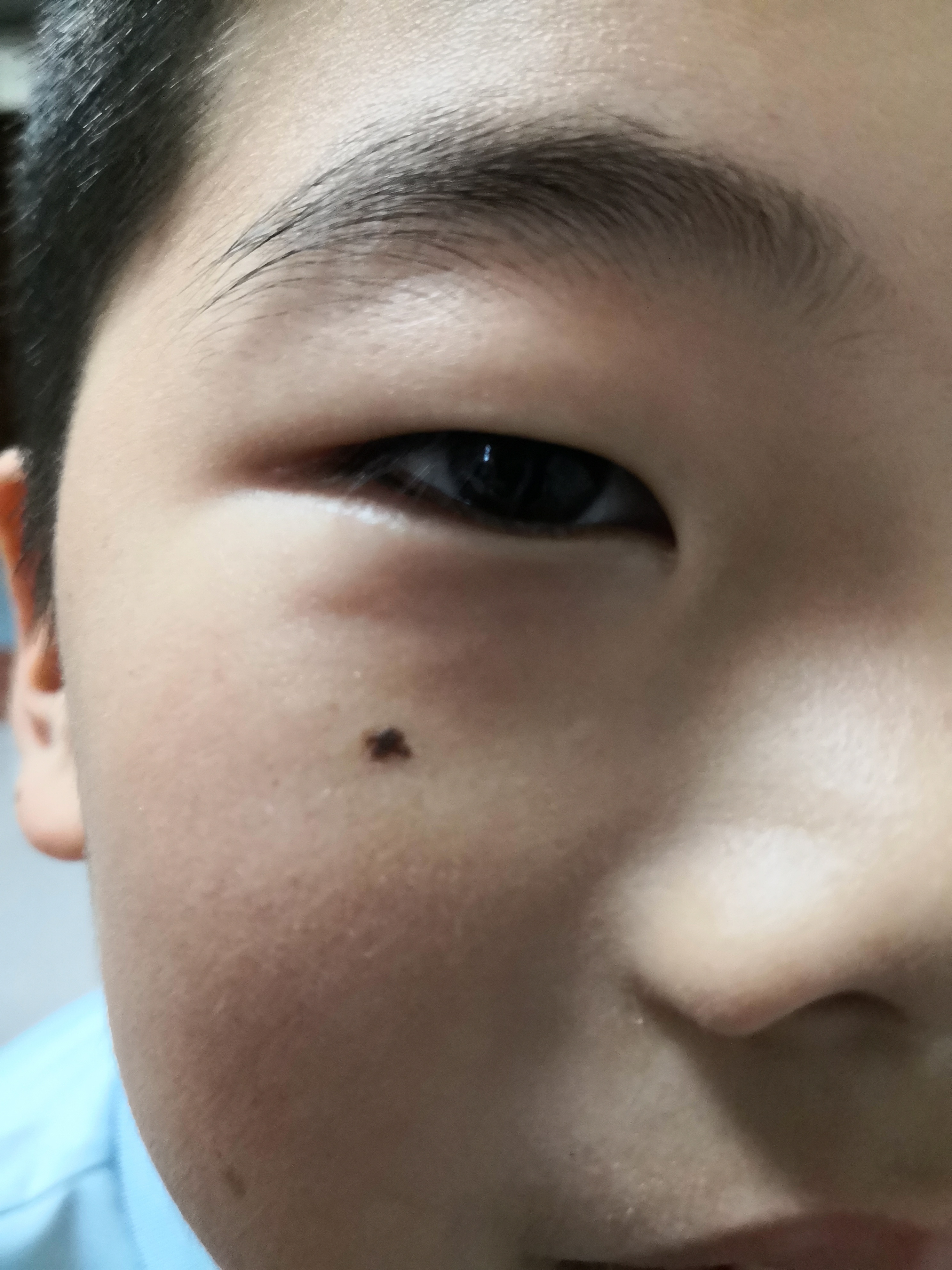 可以手术切除治疗.#解决皮肤问题专注皮肤美容##色素痣