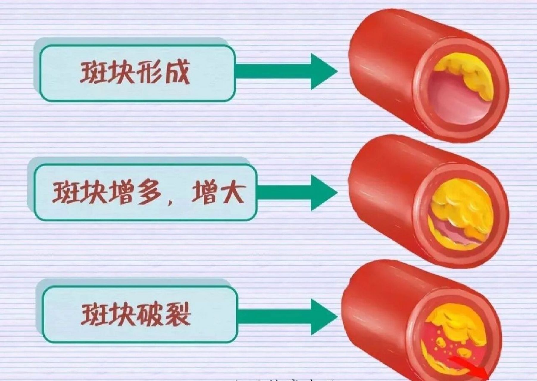 动脉粥样硬化红蓝图片