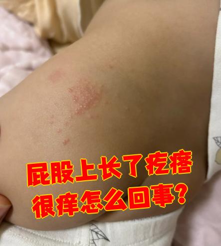 屁股上长了疙瘩很痒怎么回事?